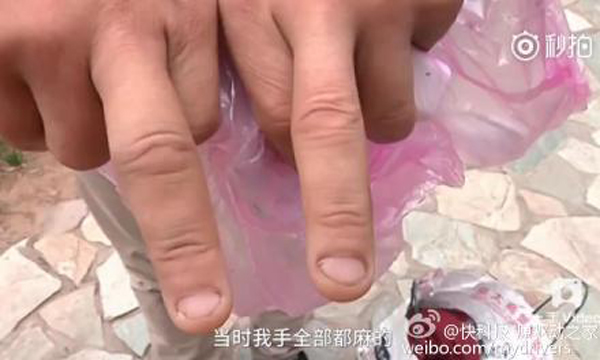 男子手部和脸部不同程度被炸伤。