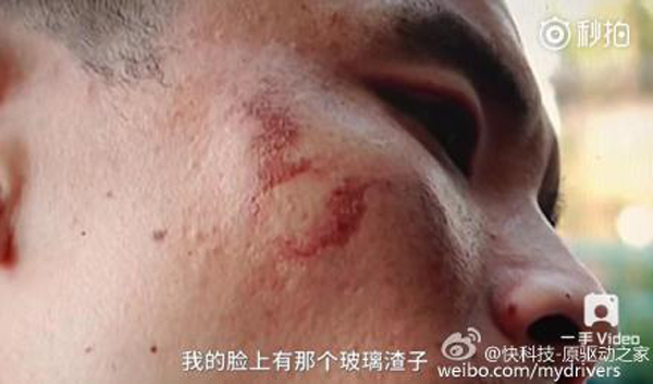 男子手部和脸部不同程度被炸伤。